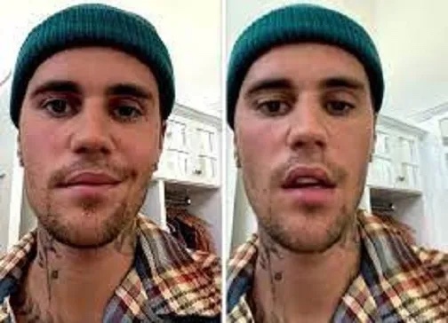 Justin Bieber Suffers Facial Paralysis