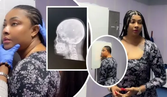 I still have pellets fragments in my head – Angela Okorie